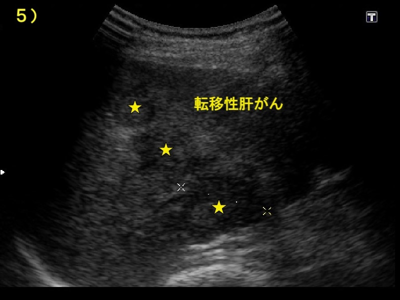 転移性肝がん